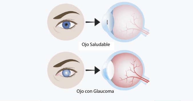 Tratamiento de glaucoma